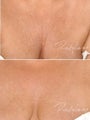 Before and after Restylane Perlane