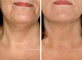 Before and after Restylane Perlane