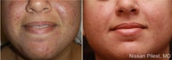 Photo Dynamic Therapy for Acne