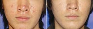 Photo Dynamic Therapy for Acne