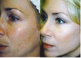 Intense Pulsed Light Treatment