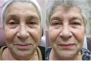 Photofacial