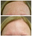 Pixel and Qs Alexandrite laser treatment