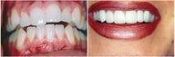 Porcelain Veneers