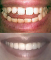 Porcelain Veneers
