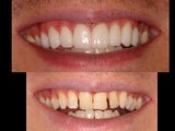 Porcelain veneers