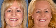 Porcelain veneers, porcelain crowns, cosmetic bonding, dental implant