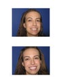 Upper  Procelain Veneers
