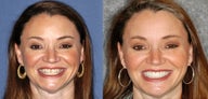 Porcelain Veneers & Bite Correction
