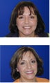 Cosmetic Dentistry- Upper Veneers and Teeth Whitening
