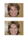 Cosmetic Dentistry- Veeners and Teeth Whitening