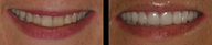 Smile Makeover Veneers