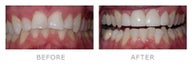 Veneers