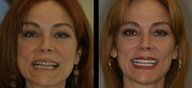 Smile Makeover with Veneers