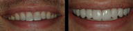 Porcelain Veneers