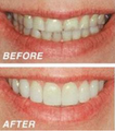 Cosmetic dentistry with composite veneers
