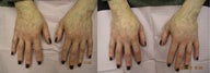 Radiesse hand rejuvenation