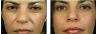 Nasolabial Filling 