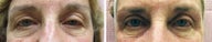 Restylane