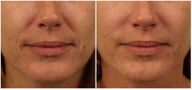 Restylane