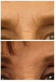 Restylane