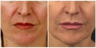 Restylane