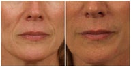 Restylane