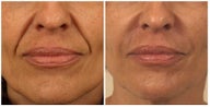 Restylane