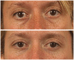 Restylane to Lower Eyelids/Tear-Trough