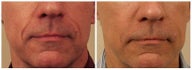 Restylane to Smile Lines