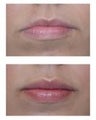 Restylane Injections for Lip Augmentation