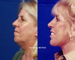 Restylane  with Facelift, Rhinoplasty, and Laser Resurfacing