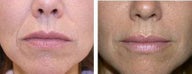 Restylane for nasal labial folds