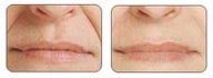 Before and after Restylane around mouth