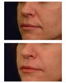 Juvederm