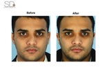 Revision Rhinoplasty 