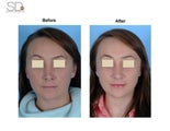 Revision Rhinoplasty 