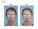 Revision Rhinoplasty