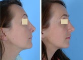 Revision Rhinoplasty