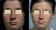 Revision Rhinoplasty