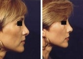 Rhinoplasty revision