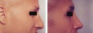 Rhinoplasty revision