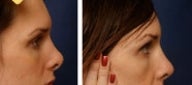 Rhinoplasty revision