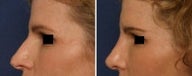 Rhinoplasty revision