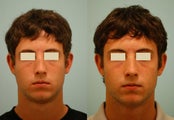 Revision/Corrective Rhinoplasty