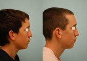 Revision/Corrective Rhinoplasty