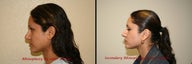 Revision Rhinoplasty