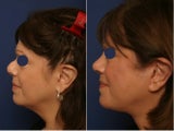 Revision rhinoplasty before and after
