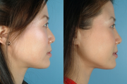 Revision Rhinoplasty