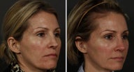 Revision Rhinoplasty and Sculptra